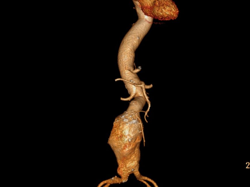 Reconstrucción 3D vascular